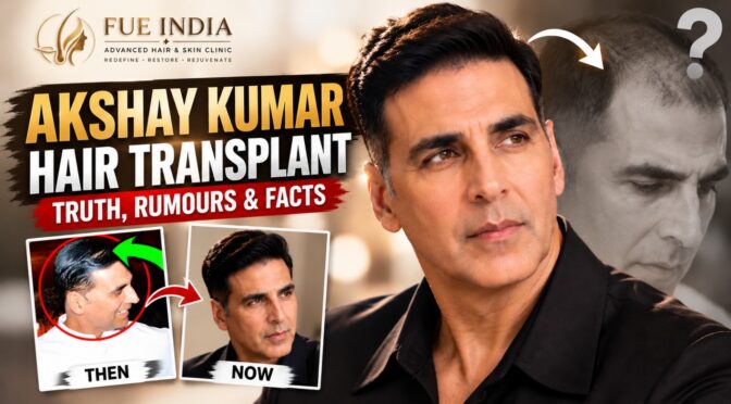 Akshay Kumar Hair Transplant